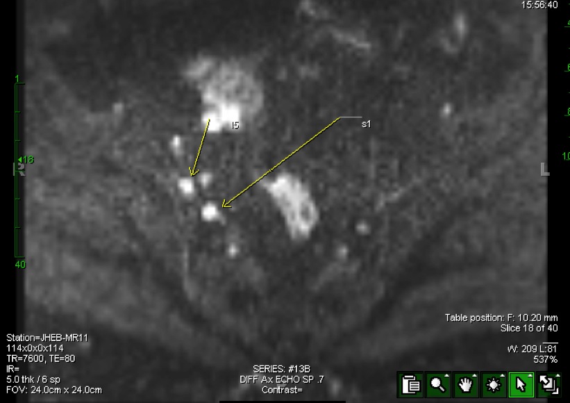 Figure 2 for case split right sciatic